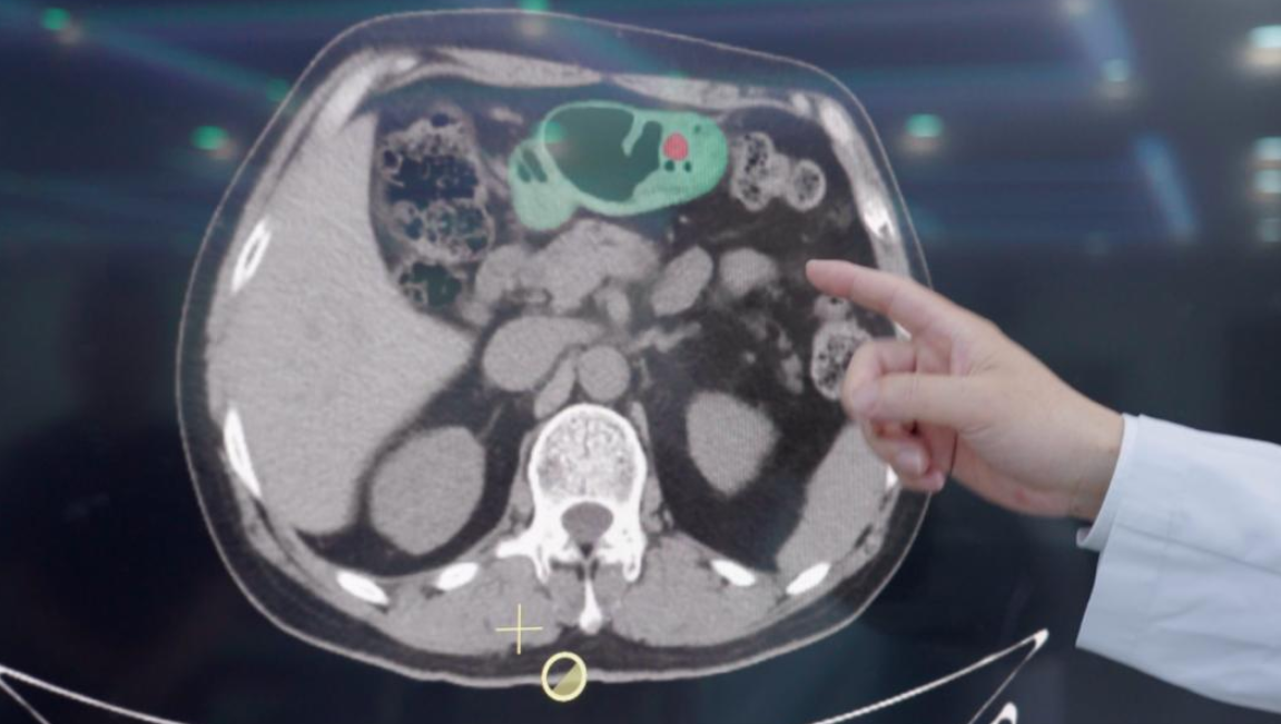 AI di China Mampu Deteksi Kanker Lambung dari CT Scan, Ini Hasilnya